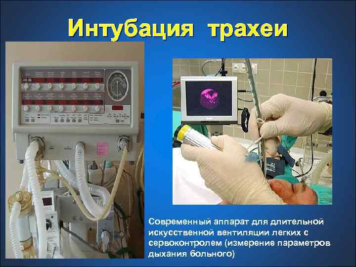 Интубация трахеи Современный аппарат для длительной искусственной вентиляции легких с сервоконтролем (измерение параметров дыхания