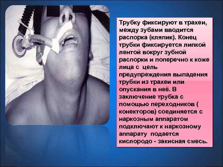 Трубку фиксируют в трахеи, между зубами вводится распорка (кляпик). Конец трубки фиксируется липкой лентой