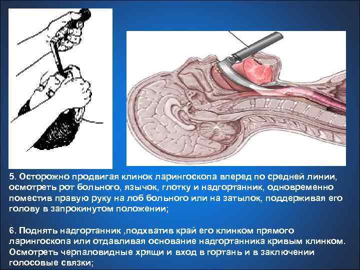 5. Осторожно продвигая клинок ларингоскопа вперед по средней линии, осмотреть рот больного, язычок, глотку