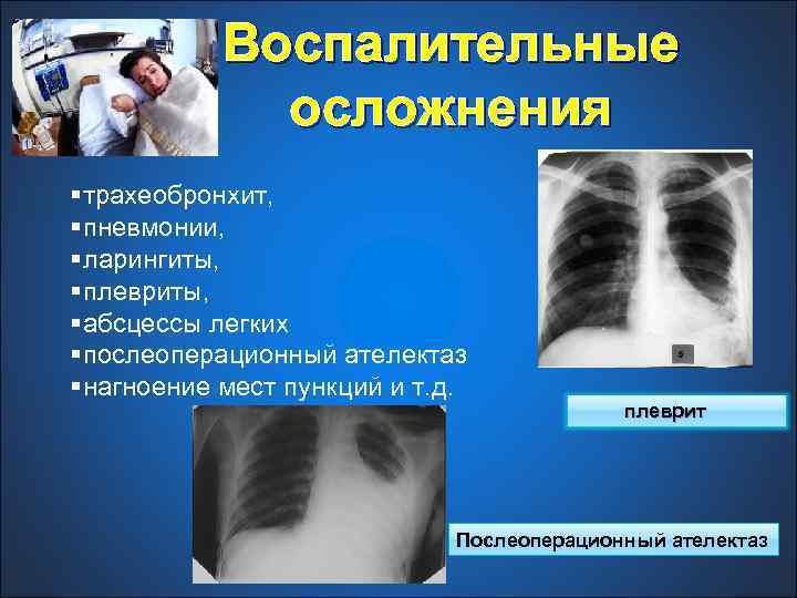 Воспалительные осложнения §трахеобронхит, §пневмонии, §ларингиты, §плевриты, §абсцессы легких §послеоперационный ателектаз §нагноение мест пункций и