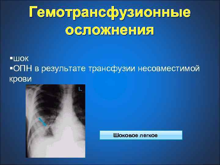 Гемотрансфузионные осложнения §шок §ОПН в результате трансфузии несовместимой крови Шоковое легкое 