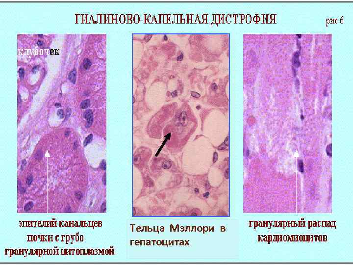 Тельца Мэллори в гепатоцитах 
