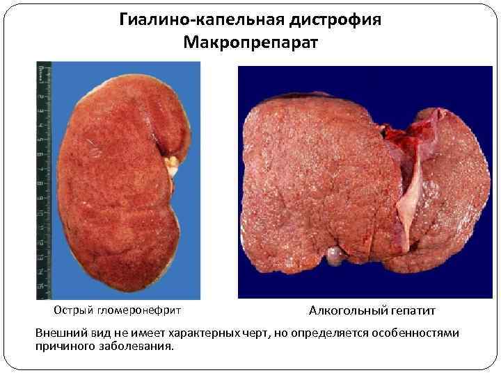 Гиалино-капельная дистрофия Макропрепарат Острый гломеронефрит Алкогольный гепатит Внешний вид не имеет характерных черт, но