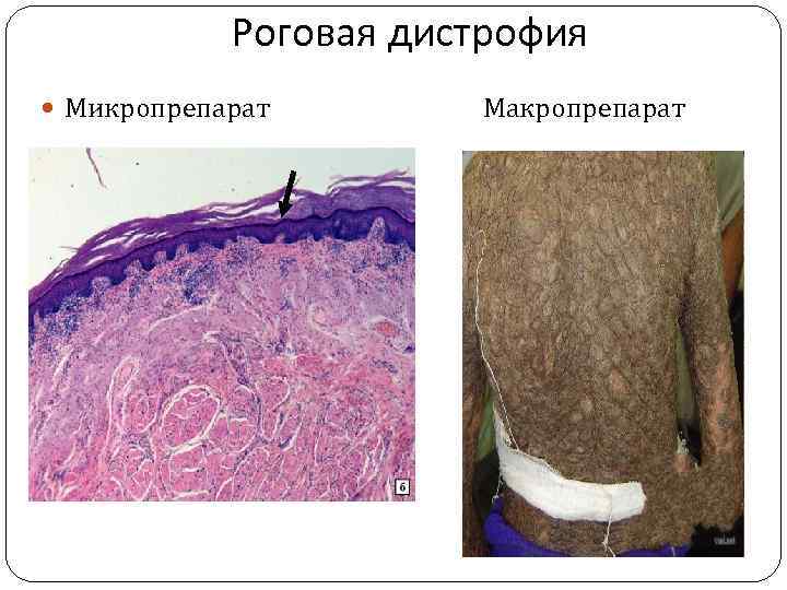 Роговая дистрофия Микропрепарат Макропрепарат 