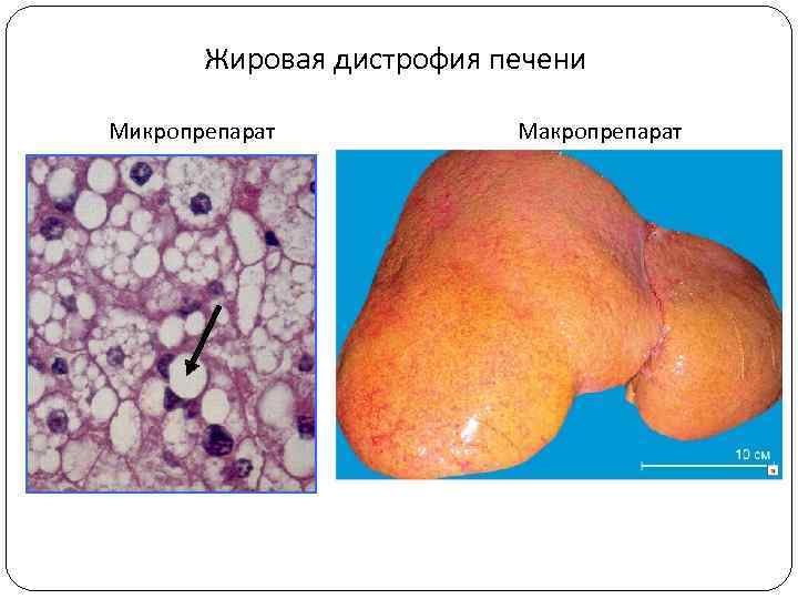 Жировая дистрофия печени Микропрепарат Макропрепарат 