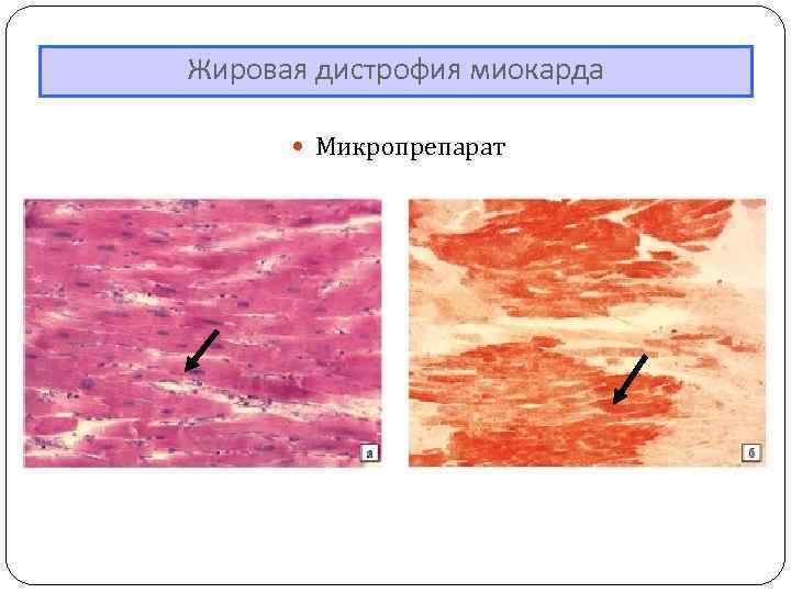 Жировая дистрофия миокарда Микропрепарат 