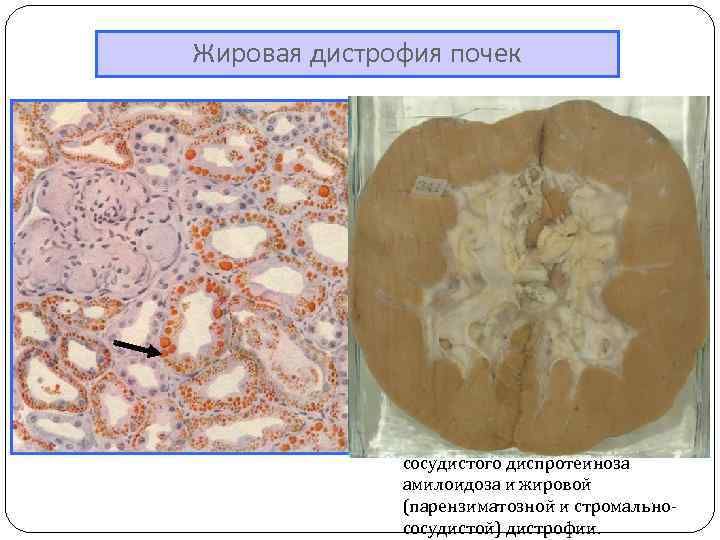 Жировая дистрофия миокарда