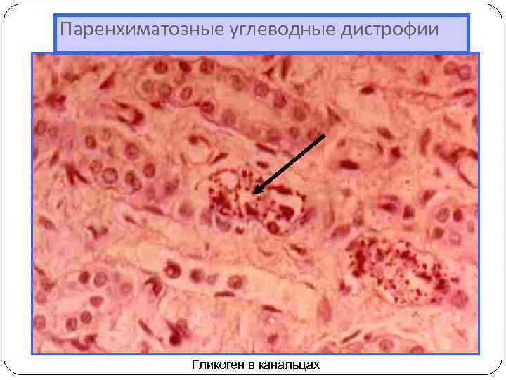 Паренхиматозные углеводные дистрофии Гликоген в канальцах 