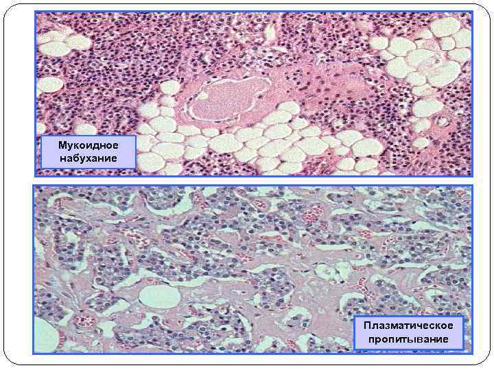 Мукоидное набухание Плазматическое пропитывание 