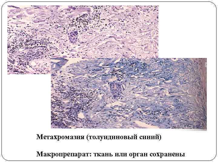 Метахромазия (толуидиновый синий) Макропрепарат: ткань или орган сохранены 