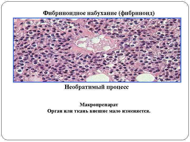 Фибриноидное набухание (фибриноид) Необратимый процесс Макропрепарат Орган или ткань внешне мало изменяется. 