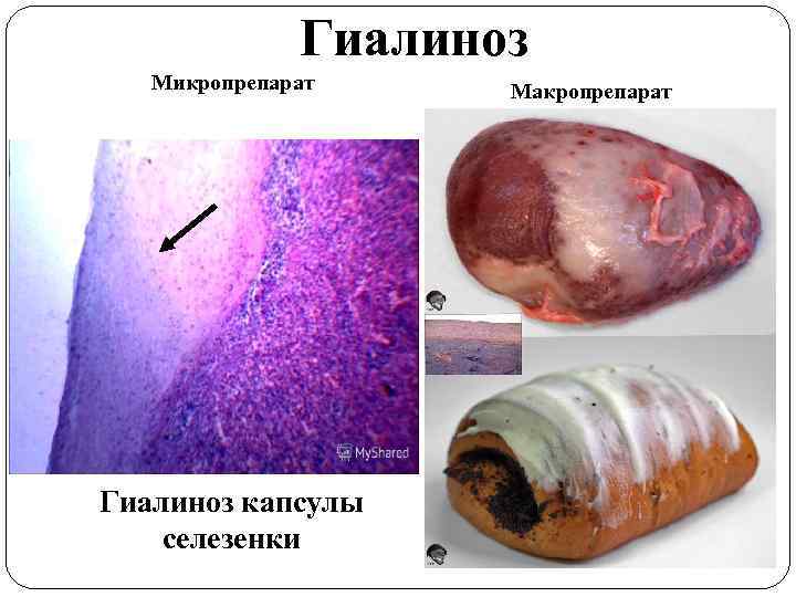 Гиалиноз Микропрепарат Гиалиноз капсулы селезенки Макропрепарат 