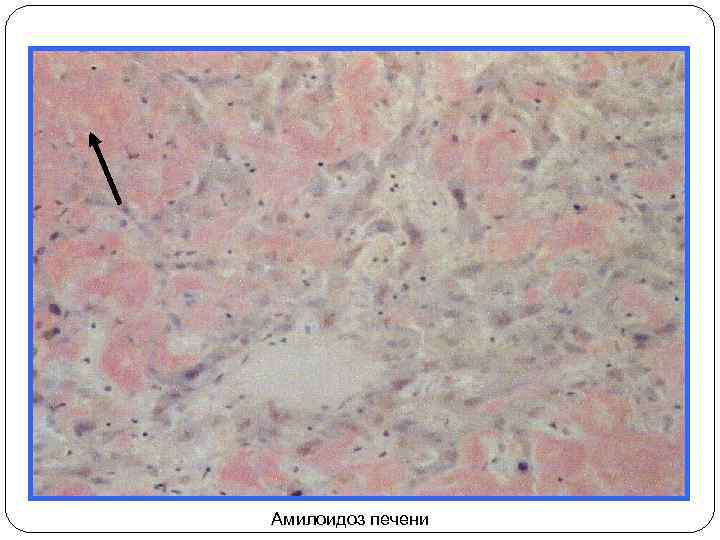 Амилоидоз печени 