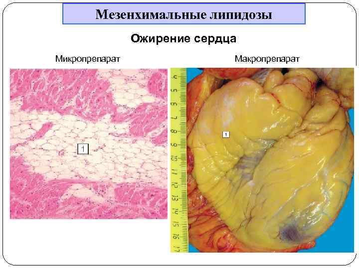 Мезенхимальные липидозы Ожирение сердца Микропрепарат Макропрепарат 