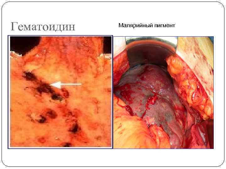 Гематоидин Малярийный пигмент 