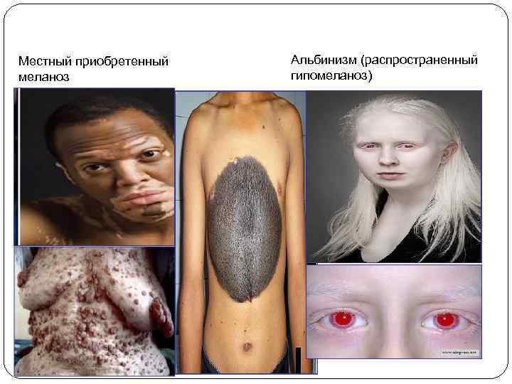 Местный приобретенный меланоз Альбинизм (распространенный гипомеланоз) 