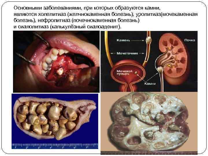 Основными заболеваниями, при которых образуются камни, являются холелитиаз (желчнокаменная болезнь), уролитиаз(мочекаменная болезнь), нефролитиаз (почечнокаменная