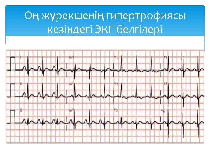 Оң жүрекшенің гипертрофиясы кезіндегі ЭКГ белгілері 