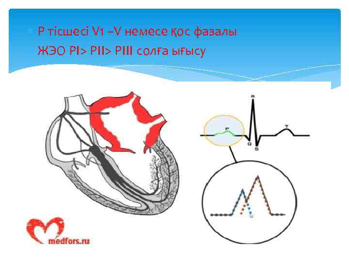  Р тісшесі V 1 –V немесе қос фазалы ЖЭО РІ> РІІІ солға ығысу