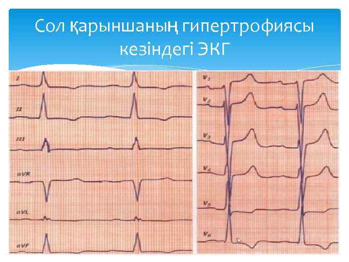 Сол қарыншаның гипертрофиясы кезіндегі ЭКГ 