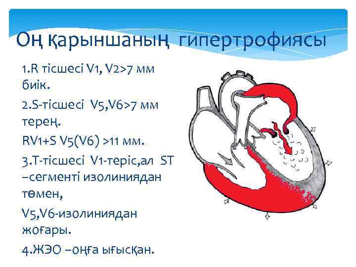Оң қарыншаның гипертрофиясы 1. R тісшесі V 1, V 2>7 мм биік. 2. S-тісшесі