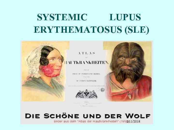 SYSTEMIC LUPUS ERYTHEMATOSUS (SLE) 2/11/2018 