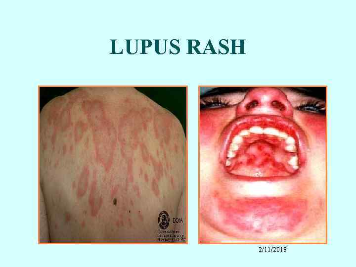 LUPUS RASH 2/11/2018 