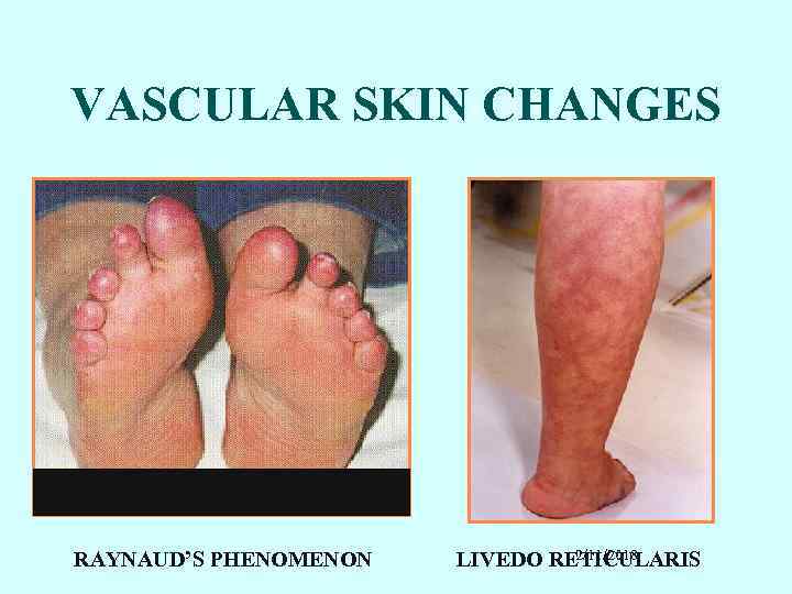 VASCULAR SKIN CHANGES RAYNAUD’S PHENOMENON 2/11/2018 LIVEDO RETICULARIS 