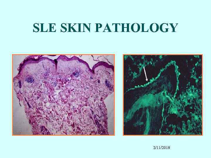 SLE SKIN PATHOLOGY 2/11/2018 