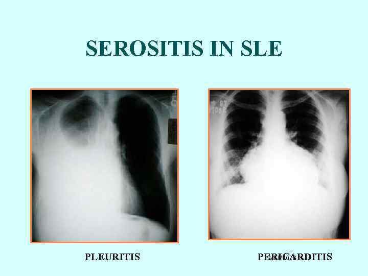 SEROSITIS IN SLE PLEURITIS PERICARDITIS 2/11/2018 