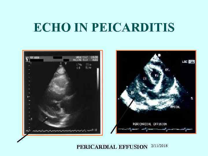 ECHO IN PEICARDITIS PERICARDIAL EFFUSION 2/11/2018 