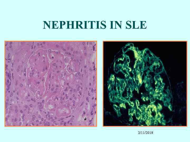 NEPHRITIS IN SLE 2/11/2018 