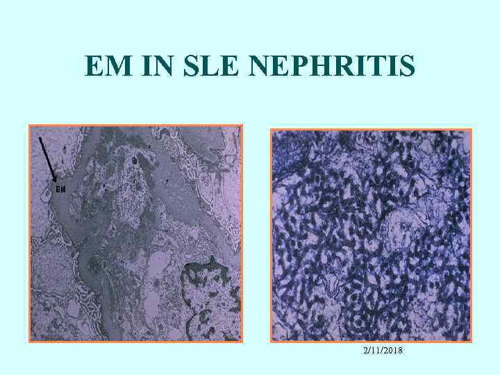 EM IN SLE NEPHRITIS 2/11/2018 