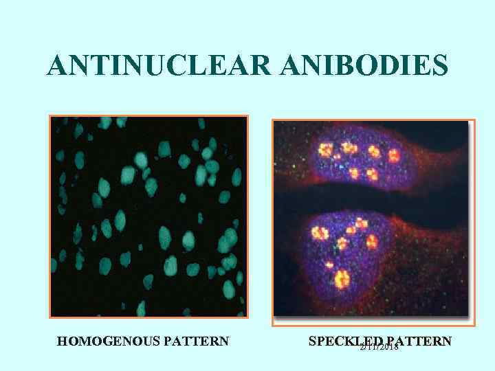 ANTINUCLEAR ANIBODIES HOMOGENOUS PATTERN SPECKLED PATTERN 2/11/2018 