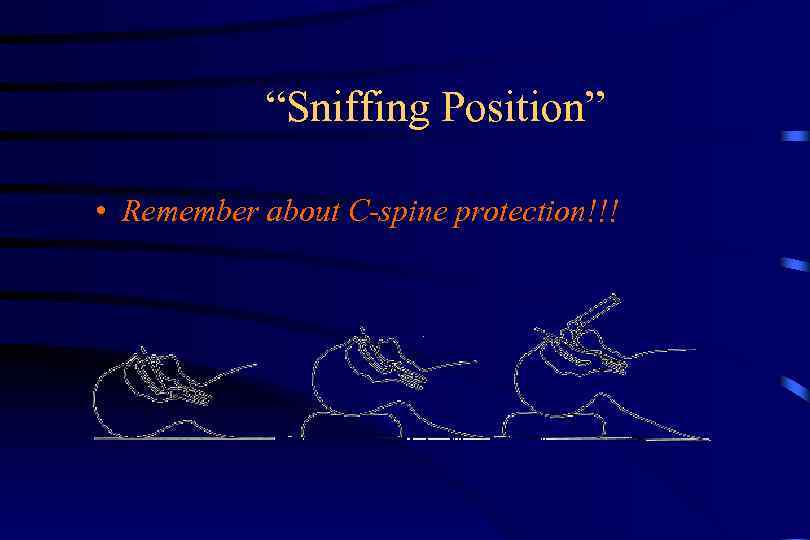 “Sniffing Position” • Remember about C-spine protection!!! 