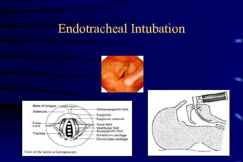 Endotracheal Intubation 