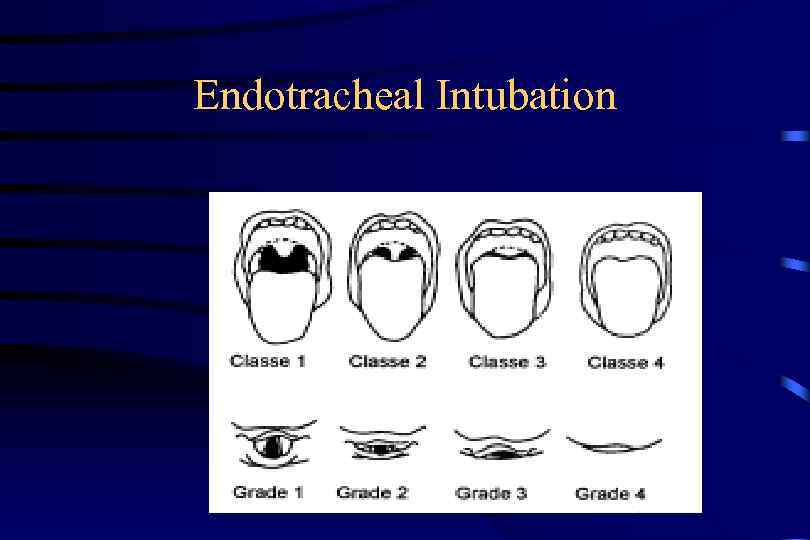 Endotracheal Intubation 