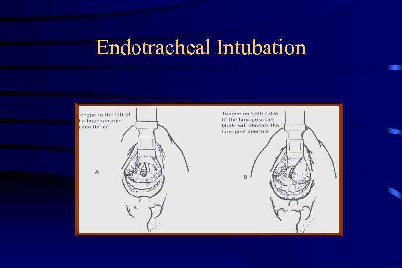 Endotracheal Intubation 