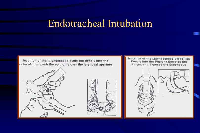 Endotracheal Intubation 