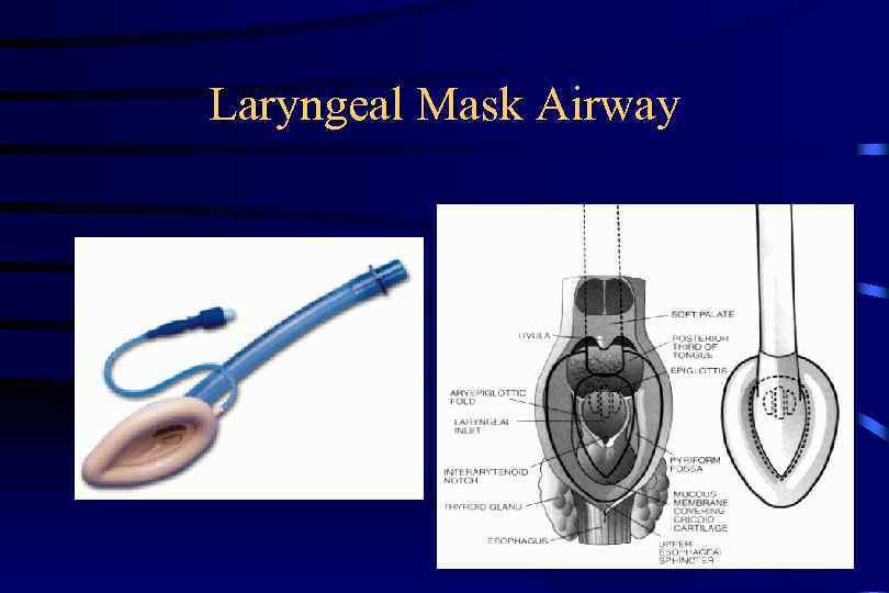Laryngeal Mask Airway 