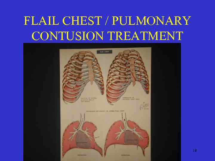 FLAIL CHEST / PULMONARY CONTUSION TREATMENT 18 