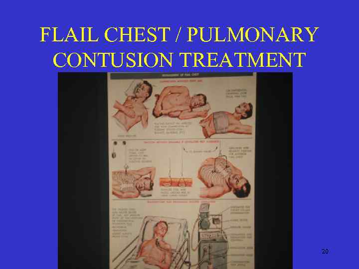 FLAIL CHEST / PULMONARY CONTUSION TREATMENT 20 