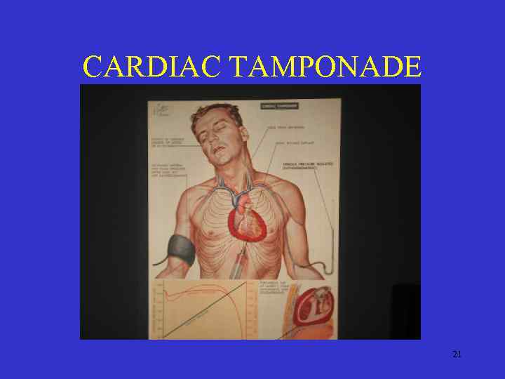 CARDIAC TAMPONADE 21 