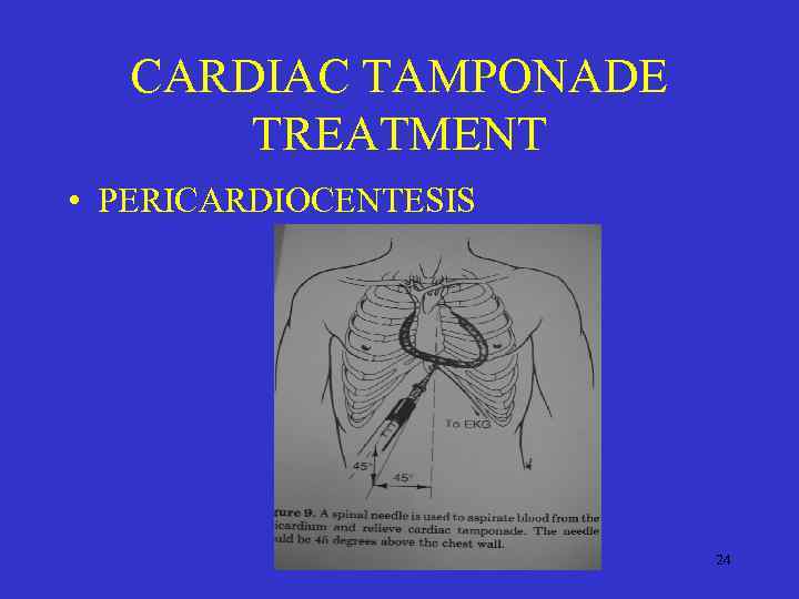 CARDIAC TAMPONADE TREATMENT • PERICARDIOCENTESIS 24 