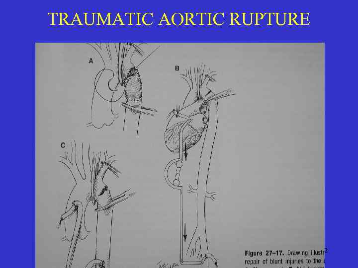 TRAUMATIC AORTIC RUPTURE 32 