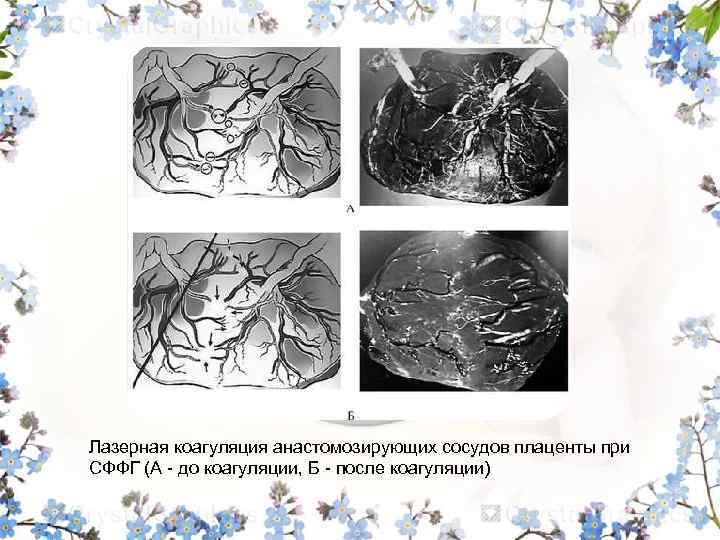 Лазерная коагуляция анастомозирующих сосудов плаценты при СФФГ (А - до коагуляции, Б - после