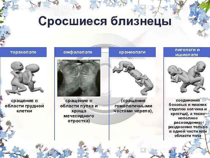 Сросшиеся близнецы торакопаги омфалопаги краниопаги сращение в области грудной клетки сращение в области пупка