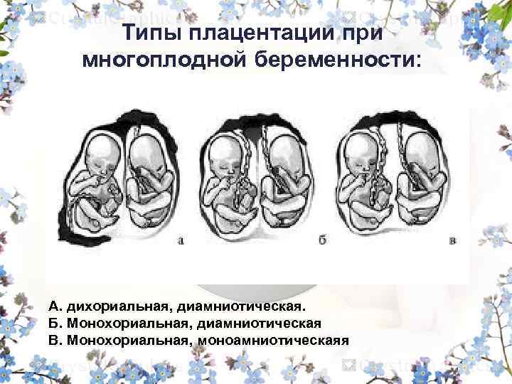 Типы плацентации при многоплодной беременности: А. дихориальная, диамниотическая. Б. Монохориальная, диамниотическая В. Монохориальная, моноамниотическаяя