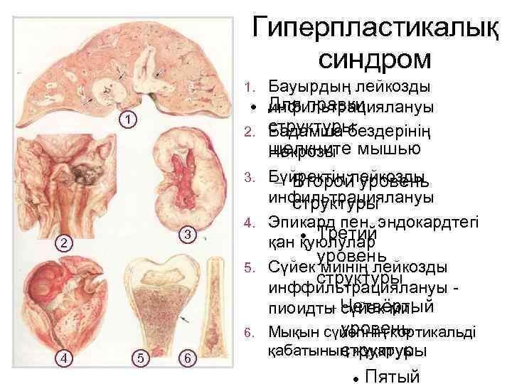 Гиперпластикалық синдром 1. 1 2. 3. 3 2 4. 5. 6. 4 5 6