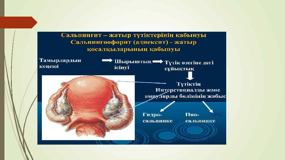 Сальпингит 